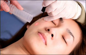 trị sẹo rỗ bằng tia laser
