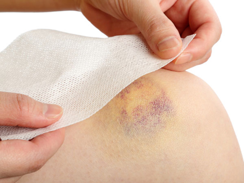 8 cách xóa tan vết bầm tím trên cơ thể