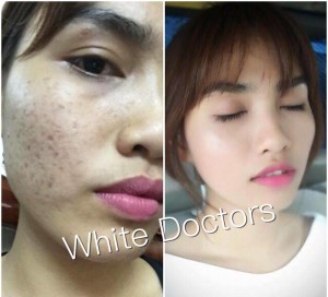 Trị mụn đúng cách